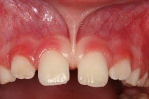 6frenillo-labial-300x200