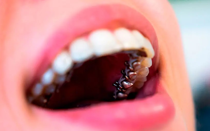 ejemplo de ortodoncia lingual