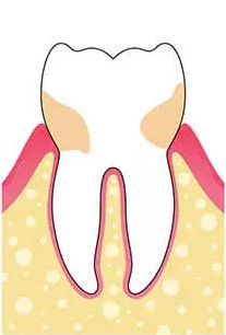 gráfico que muestra síntomas de periodontitis incipiente