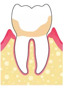 gráfico que muestra periodontitis avanzada