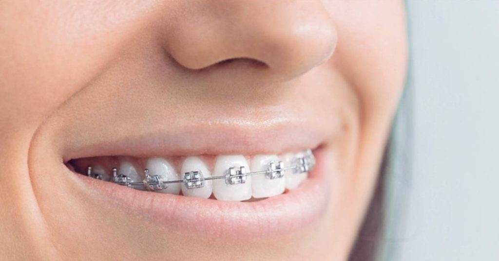 brackets dentales transparentes ortodoncia discreta