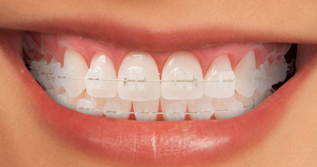 ejemplo de brackets blancos muy discretos